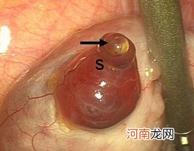 感觉肛门下坠可能是排卵了