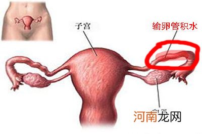 多囊卵巢综合症容易受孕吗