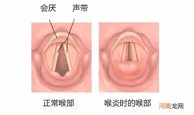 咽喉炎按摩方法视频