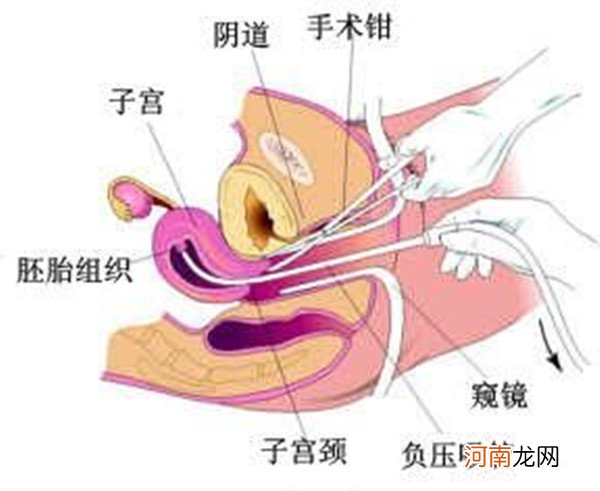 人流后要做多久的月子 小月子可以玩手机吗