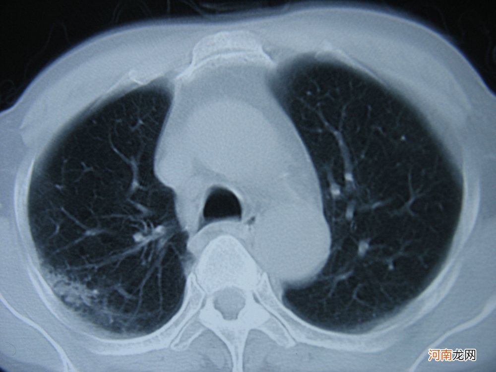 肺部隐隐作痛是癌症吗