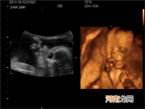 24周胎儿生殖图片