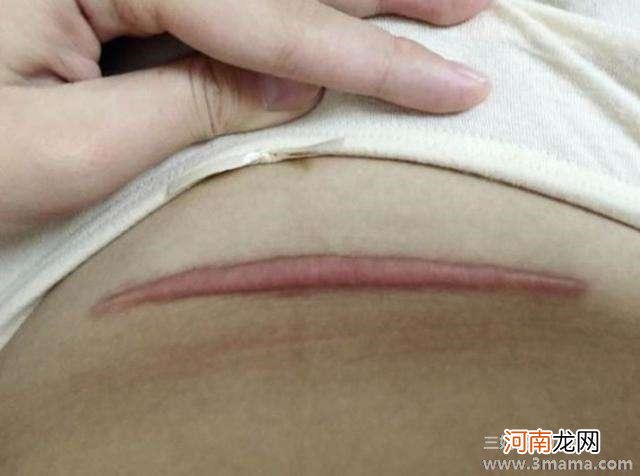 妇科专家：疤痕体质的人避免做剖腹产