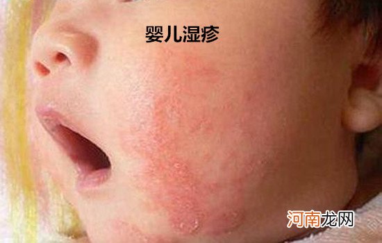 新生儿湿疹和热疹的区别在哪里 5张图片教你读懂
