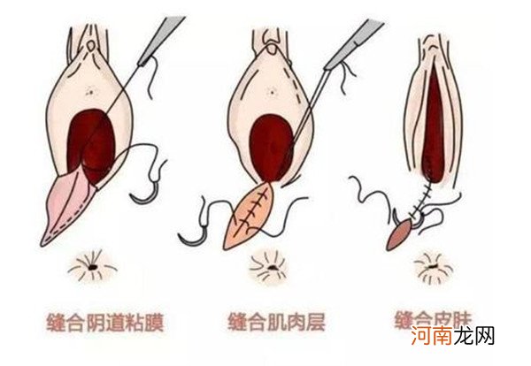 侧切伤口是冲洗还是擦洗 如何清洗的步骤解答