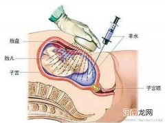 华西医院羊水穿刺价格