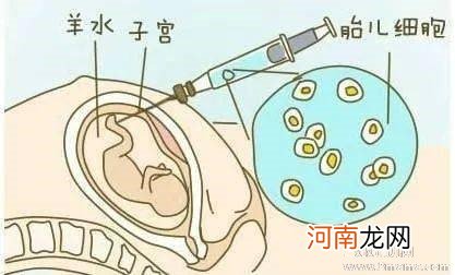 羊水穿刺家属让进吗