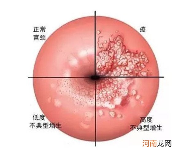 二价,四价,九价哪个值得打 比一比就知道答案