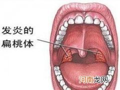 腺样体肥大千万别手术