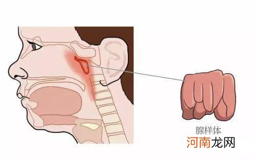 腺样体肥大正确睡姿