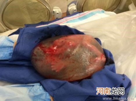 羊水少一定要剖腹产吗