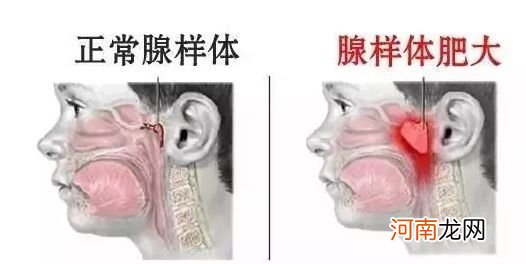 腺样体肥大怎么治