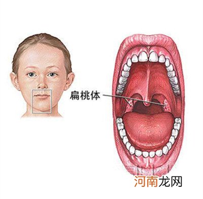 扁桃体肥大要手术吗