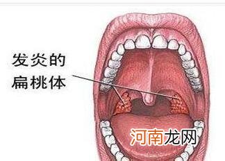 扁桃体肥大偏方淡盐水