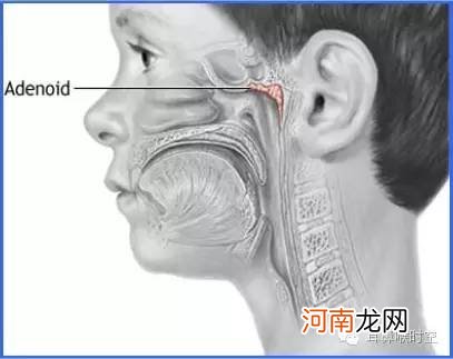 怎么判断小孩腺样体肥大