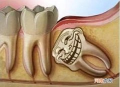 拔智齿微创多少钱啊