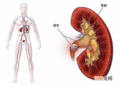 肾结石饮食禁忌