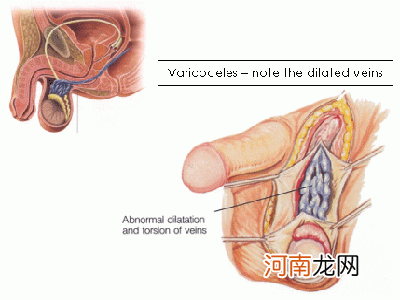 中度精索静脉曲张原因