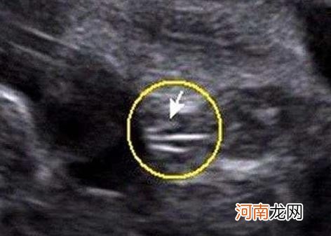 原来男宝宝的B超是这样的 胎儿b超单子怎么看男女
