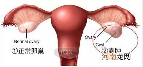 鼻骶囊肿手术多少钱