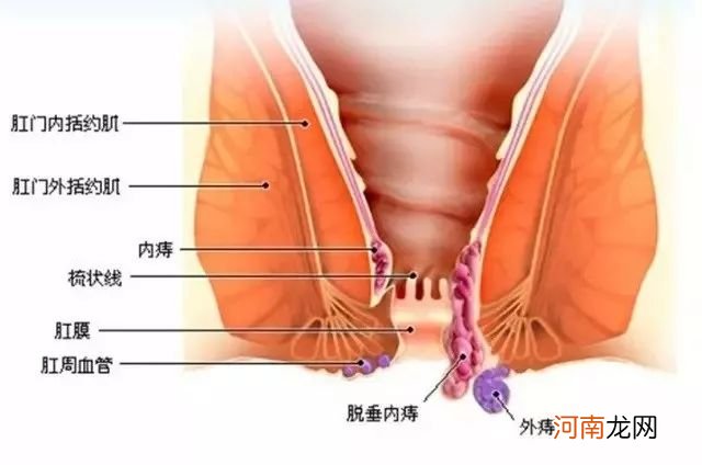 痔疮是长什么样图片