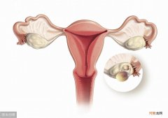卵巢畸胎瘤尽量不做手术 畸胎瘤不做手术可以吗有什么后果