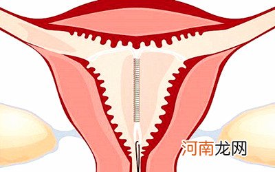 女人上环以后会怀孕吗 现在女性还需要上环吗