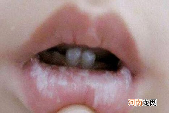 婴儿鹅口疮最佳治疗方法 为了宝宝赶紧收藏