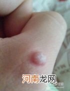 手上长瘊子是什么病毒