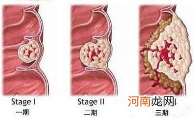 痔疮痛的难以入睡怎么办