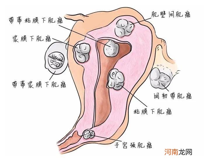 4厘米子宫肌瘤怎么治疗