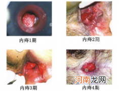 痔疮有哪些症状表现女性