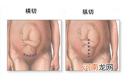 不得不选择剖腹产的4种情况