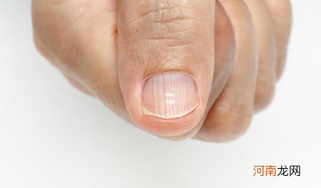 指甲有竖纹是怎么回事 指甲有竖纹的原因是什么