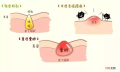 初中生脸上长粉刺怎么治疗