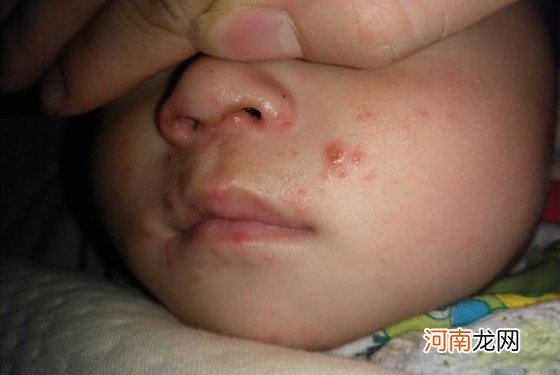 附水痘止痒妙招 小孩长水痘的图片 有多少宝妈了解过
