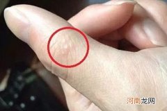 孩子手上长水泡很痒怎么办 别急可以这样做治疗