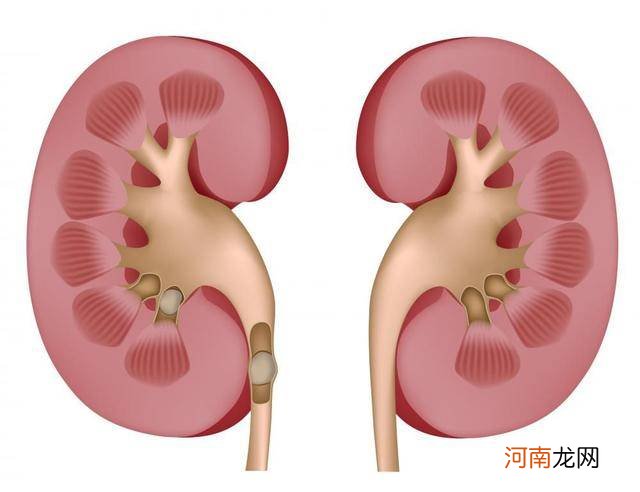 肾结石10分钟止痛