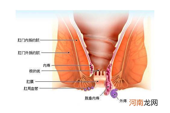 肛门长了尖尖的肉芽不痛不痒