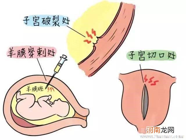 产后四天羊水栓塞死亡