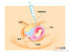 羊水穿刺没过后生下来