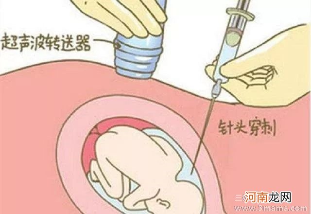 孕妇做羊水穿刺对胎儿有影响吗