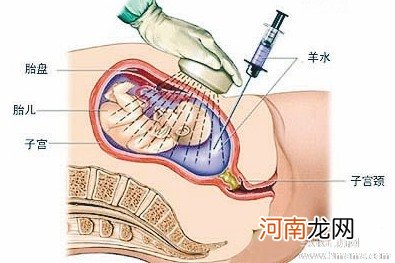 羊水穿刺最疼有多疼