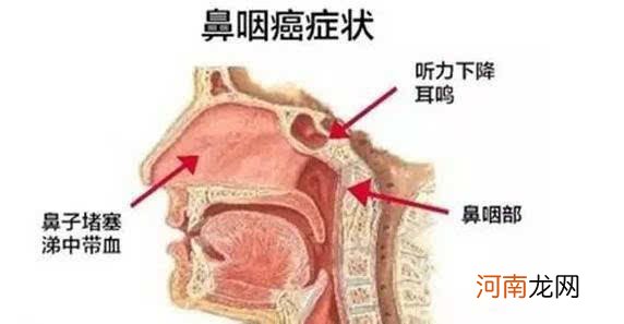 鼻癌头痛是什么症状