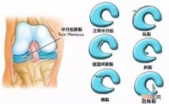 半月板损伤多久可以恢复