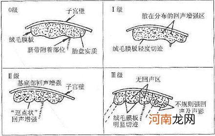 32周胎盘成熟度一到二级