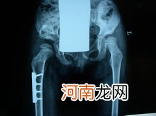 髋关节错位什么症状