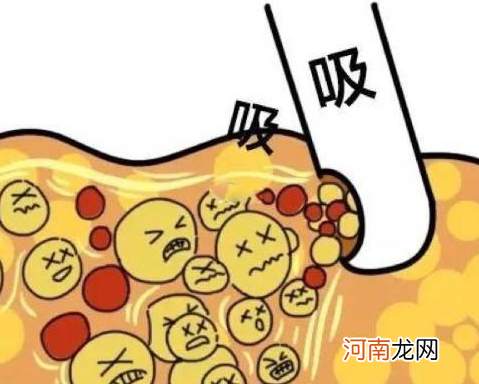 腰腹吸脂一次能吸多少