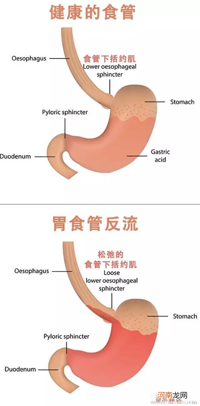 孕晚期胃酸烧心怎么办