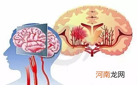 脑血管破裂怎么急救